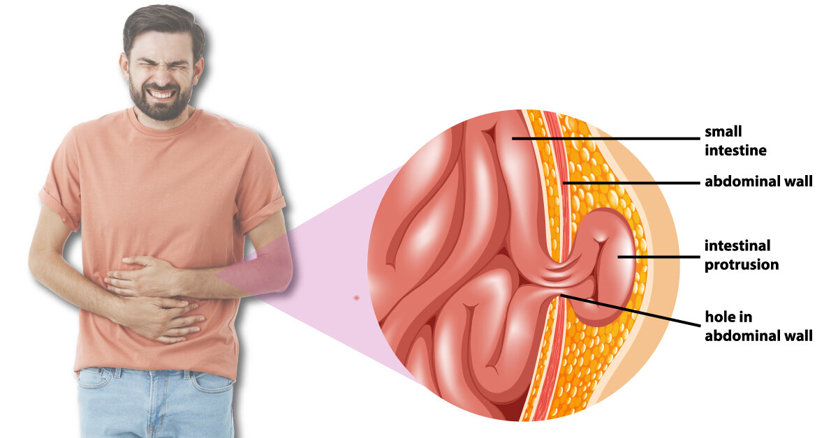 Signs to look if you have Hernia!